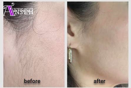 نمونه کار لیزر کنار گوش در کلینیک زیبایی آنسه