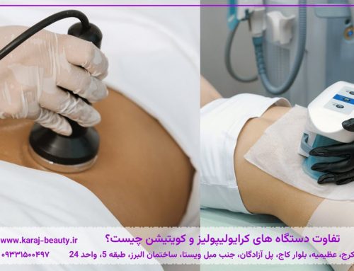 تفاوت کرایولیپولیز و کویتیشن، کدام روش برای لاغری موضعی بهتر است؟
