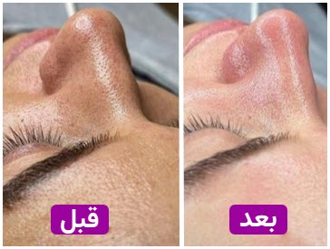 قیل و بعد فشیال | کلینیک زیبایی آنسه در کرج