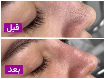 قیل و بعد فشیال | کلینیک زیبایی آنسه در عظیمیه کرج