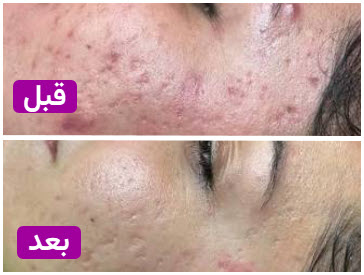 قیل و بعد فشیال | کلینیک زیبایی آنسه در آزادگان کرج
