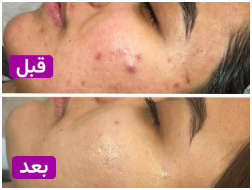قیل و بعد فشیال | کلینیک زیبایی آنسه در بلوار کاج کرج