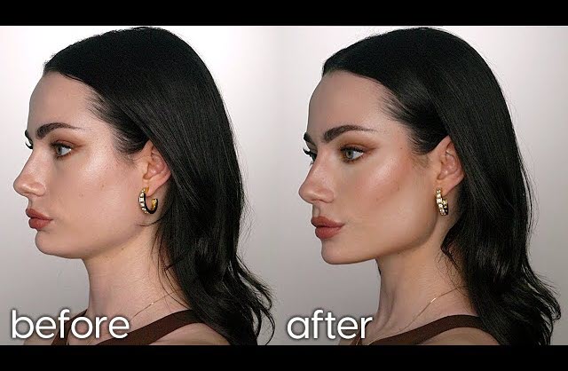 عکس قبل و بعد زاویه سازی صورت و فک در کلینیک آنسه