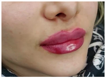 نمونه کار تزریق ژل لب | کلینیک آنسه در آزادگان کرج