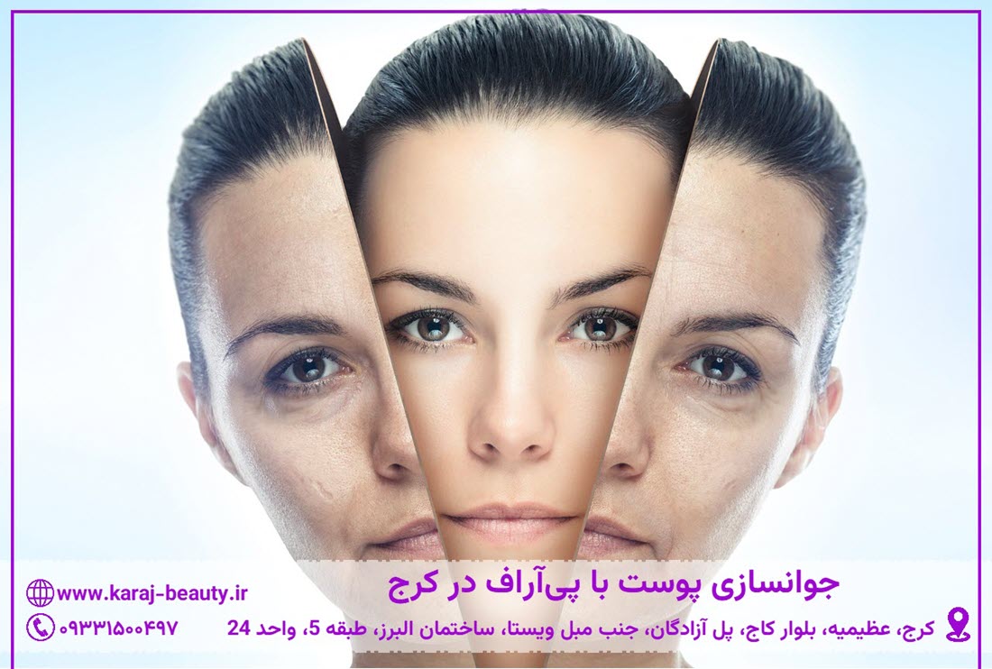 پی آر اف صورت در کرج | کلینیک زیبایی آنسه