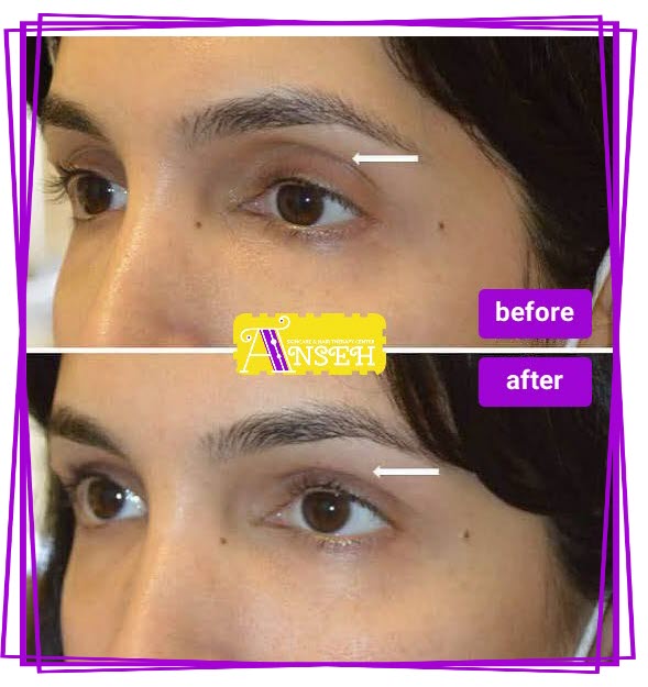 تزریق ژل پشت پلک نی نی سایت | کلینیک آنسه