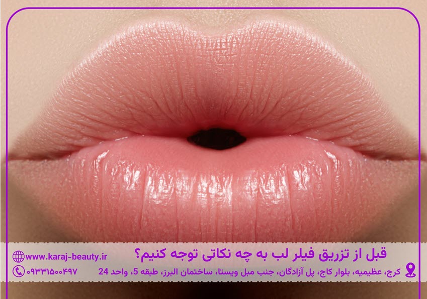 قبل از تزریق فیلر لب به چه نکاتی توجه کنیم؟ | کلینیک زیبایی آنسه
