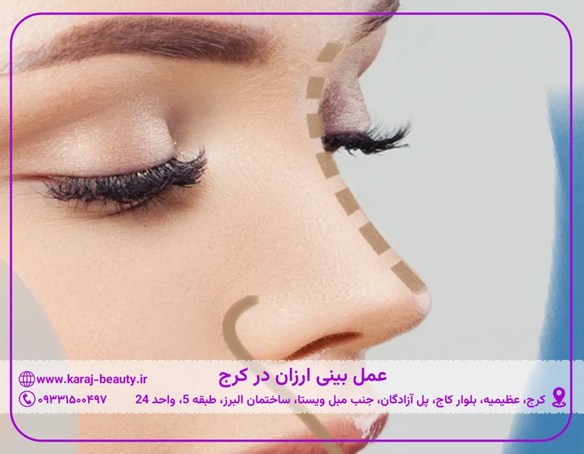 عمل بینی ارزان در کرج | کلینیک زیبایی آنسه در عظیمیه کرج