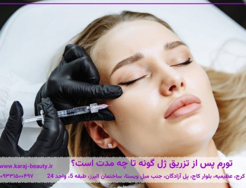 ورم بعد از تزریق ژل گونه چند روز طول میکشد؟ + راهکارهای کاهش سریع تورم