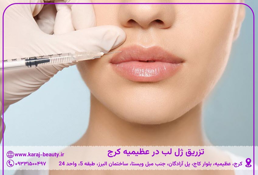 تزریق ژل لب در عظیمیه کرج | کلینیک زیبایی آنسه عظیمیه
