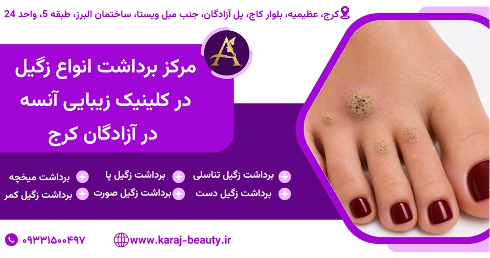 ليزر زگيل پا در كرج كجاست؟ هزينه، روش درمان و انتخاب پزشك